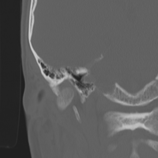 Acoustic schwannoma - eroding petrous apex (Radiopaedia 39674-42002 Coronal bone window 37).png