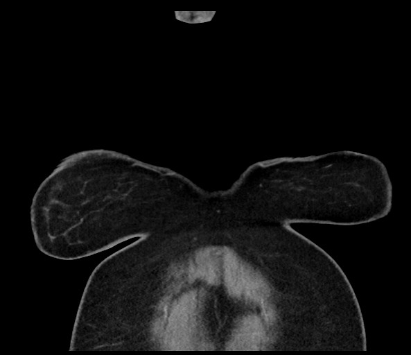 Acromioclavicular joint cyst (Radiopaedia 58455-65610 Coronal C+ arterial phase 16).jpg
