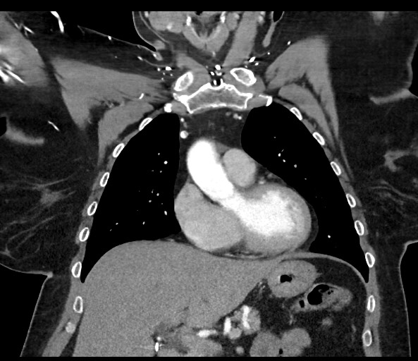 Acromioclavicular joint cyst (Radiopaedia 58455-65610 Coronal C+ arterial phase 59).jpg