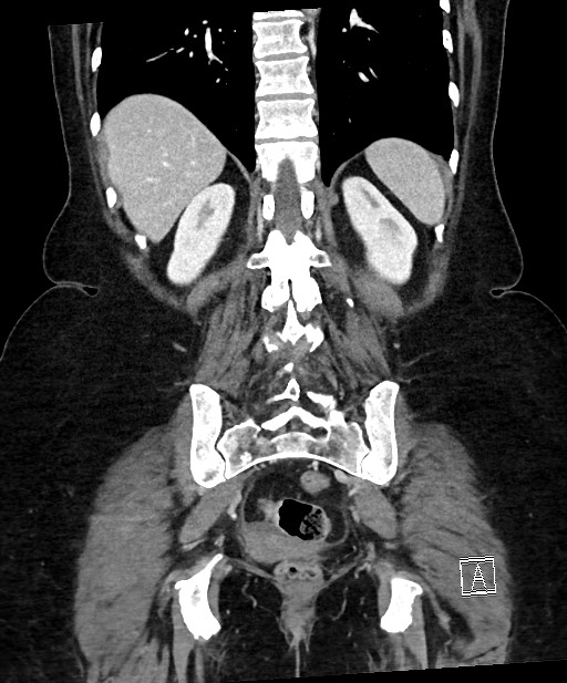 Active Crohn disease (Radiopaedia 59394-66750 Coronal C+ portal venous phase 53).jpg