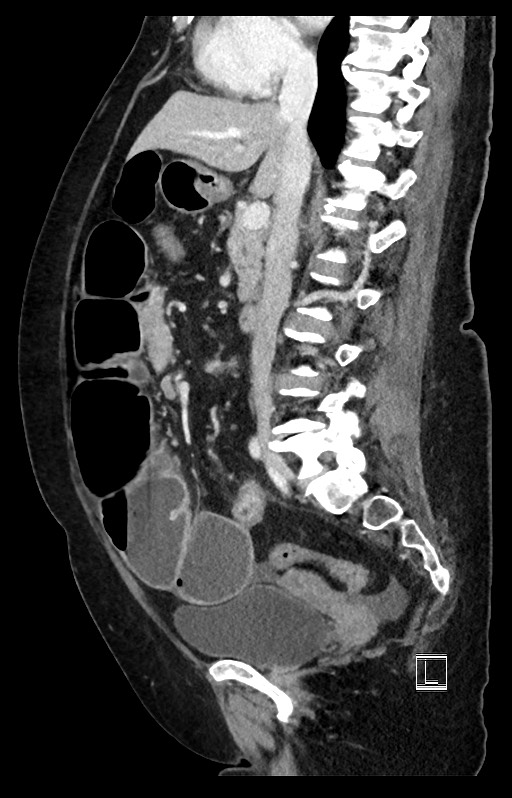 Active Crohn disease (Radiopaedia 59394-66750 Sagittal C+ portal venous phase 32).jpg