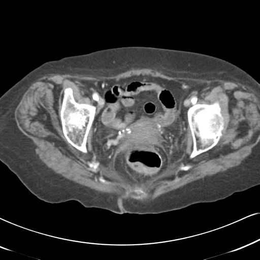 File:Active bleeding from duodenal ulcer with embolization (Radiopaedia 34216-35481 C 60).png