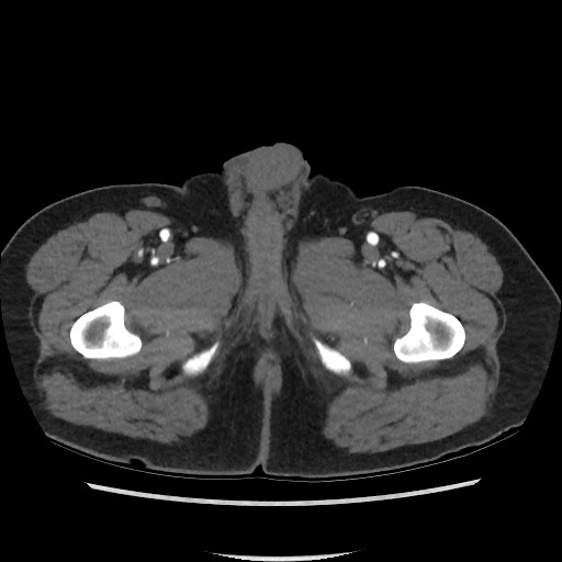 File:Active colonic bleed on CT (Radiopaedia 49765-55025 Axial C+ arterial phase 92).jpg
