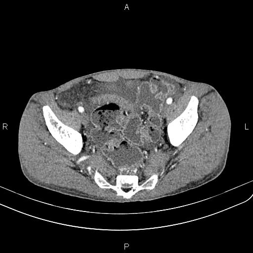 Active crohn disease (Radiopaedia 87133-103397 Axial C+ arterial phase 87).jpg