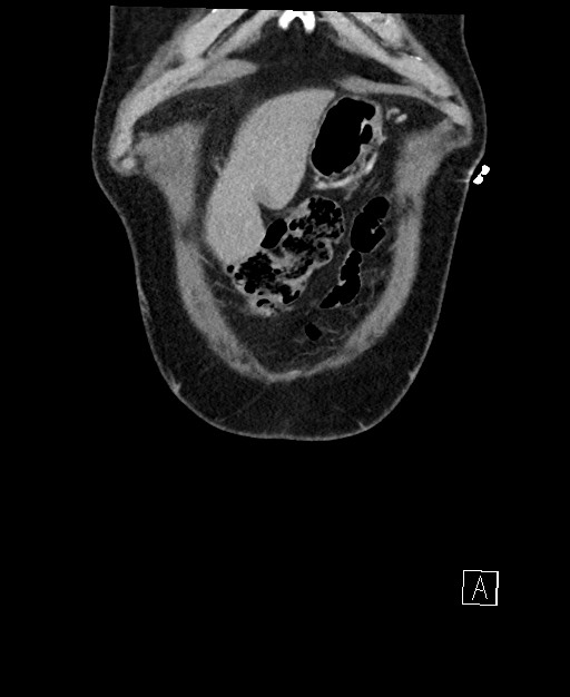 Active lower gastrointestinal bleeding - diverticular (Radiopaedia 61203-69106 Coronal C+ portal venous phase 14).jpg