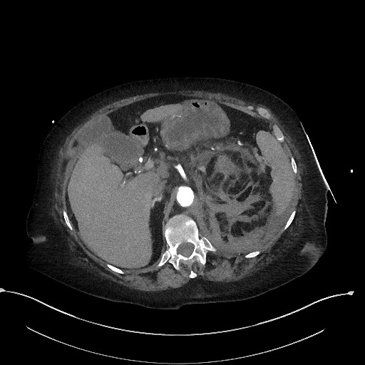Active renal extravasation with large subcapsular and retroperitoneal hemorrhage (Radiopaedia 60975-68796 Axial C+ arterial phase 58).jpg