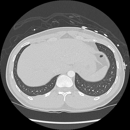 File:Active right ventricular cardiac sarcoidosis (Radiopaedia 55596-62101 Axial lung window 45).jpg