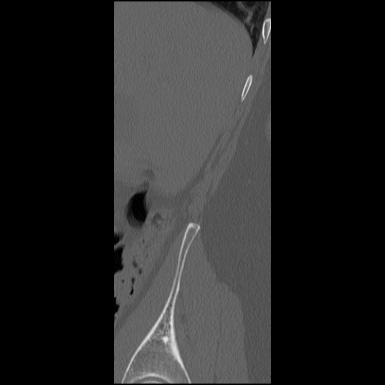 Acute Schmorl's node (Radiopaedia 83276-102365 Sagittal bone window 82).jpg