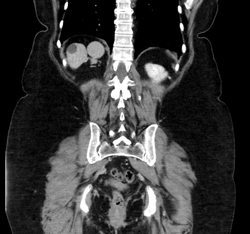 Acute appendicitis, heterotaxy syndrome (Radiopaedia 66884-76202 Coronal C+ portal venous phase 95).jpg