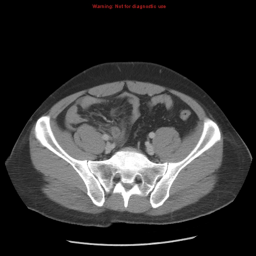 Acute appendicitis (Radiopaedia 10498-10973 Axial C+ portal venous phase 31).jpg