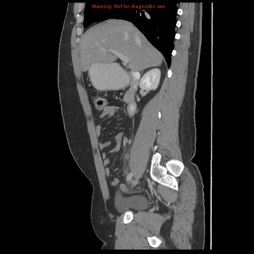 File:Acute appendicitis (Radiopaedia 10498-10973 Sagittal C+ portal venous phase 15).jpg