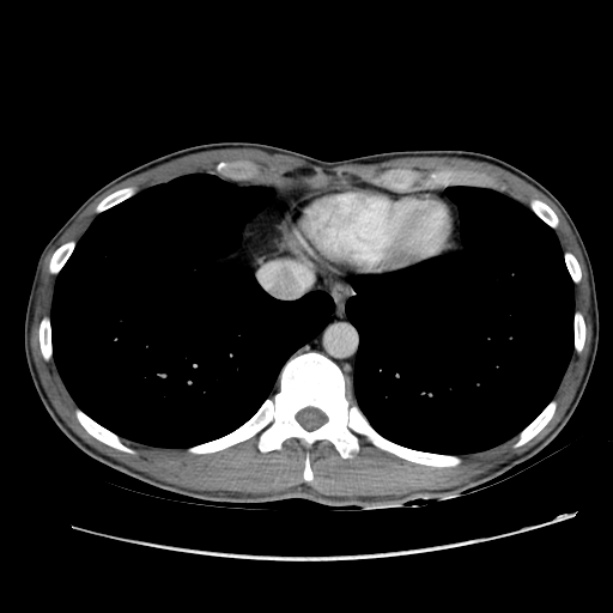 Acute appendicitis (Radiopaedia 27049-27227 Axial C+ portal venous phase 4).jpg