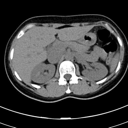 Acute appendicitis (Radiopaedia 30261-30888 Axial non-contrast 15).jpg