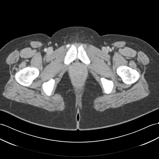 Acute appendicitis (Radiopaedia 30297-30934 Axial C+ portal venous phase 85).jpg