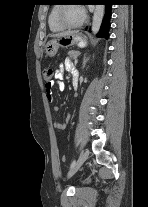 Acute appendicitis (Radiopaedia 48511-53463 Sagittal C+ portal venous phase 83).jpg