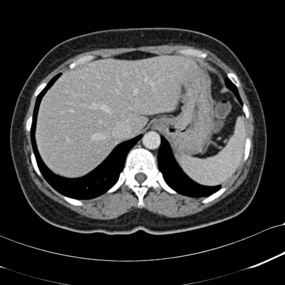 File:Acute appendicitis (Radiopaedia 48792-53822 Axial C+ portal venous phase 18).jpg