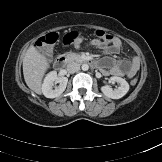File:Acute appendicitis (Radiopaedia 48792-53822 Axial C+ portal venous phase 46).jpg