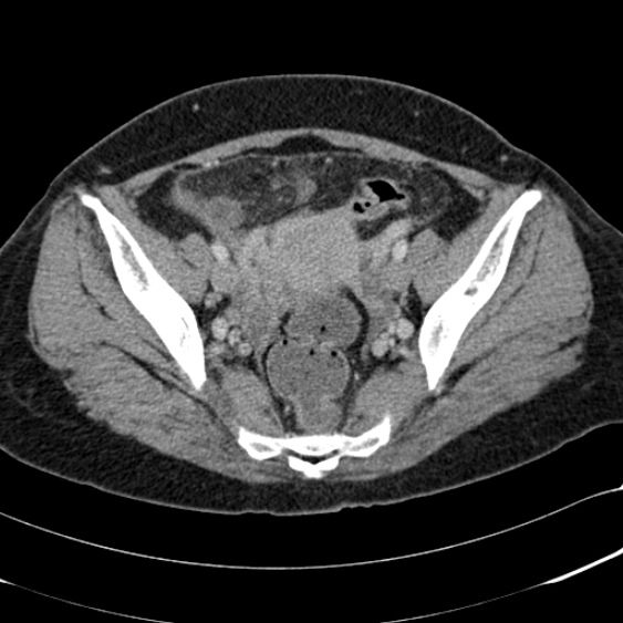 File:Acute appendicitis (Radiopaedia 48792-53822 Axial C+ portal venous phase 96).jpg