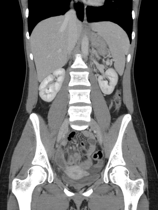 Acute appendicitis (Radiopaedia 62608-70901 Coronal C+ portal venous phase 28).jpg