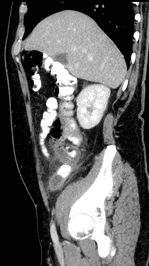 Acute appendicitis (Radiopaedia 77016-88960 Sagittal C+ portal venous phase 84).jpg