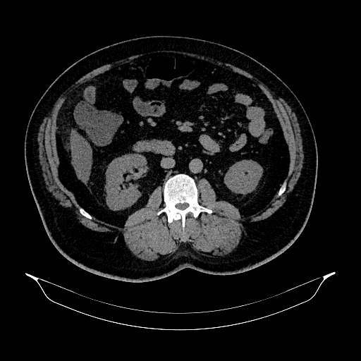 Acute appendicitis (Radiopaedia 79950-93224 Axial non-contrast 48).jpg