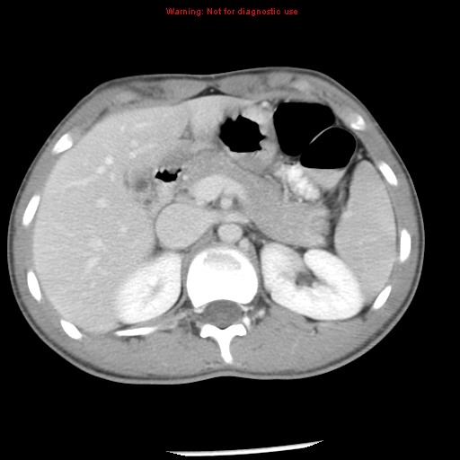 Acute appendicitis (Radiopaedia 8195-9045 Axial C+ portal venous phase 22).jpg