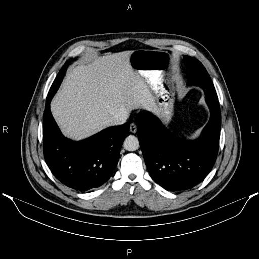 Acute appendicitis (Radiopaedia 84780-100240 Axial C+ portal venous phase 13).jpg