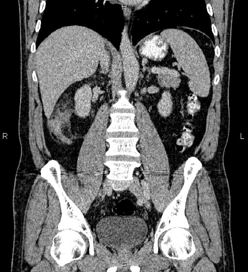 Acute appendicitis (Radiopaedia 84780-100240 Coronal C+ portal venous phase 48).jpg