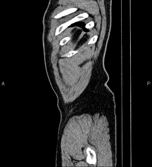 Acute appendicitis (Radiopaedia 84780-100240 Sagittal C+ portal venous phase 105).jpg