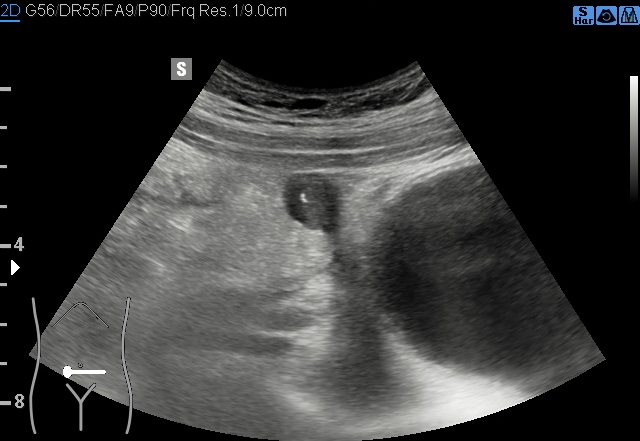 File:Acute appendicitis (Radiopaedia 85193-100745 B 121).jpg