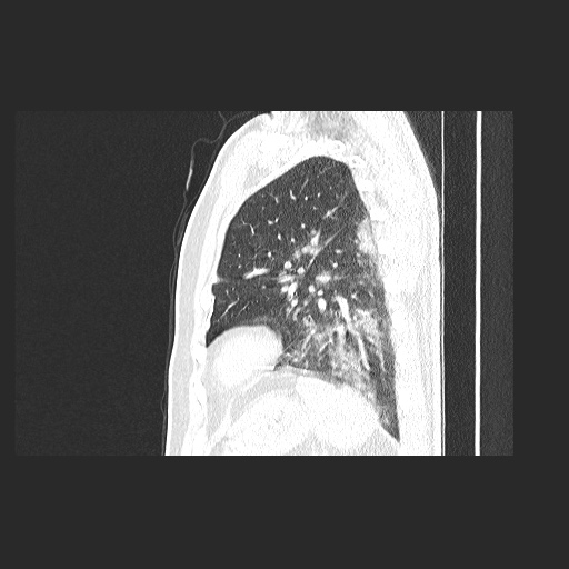 Acute appendicitis and COVID 19 pneumonia (Radiopaedia 76604-88380 Sagittal lung window 72).jpg