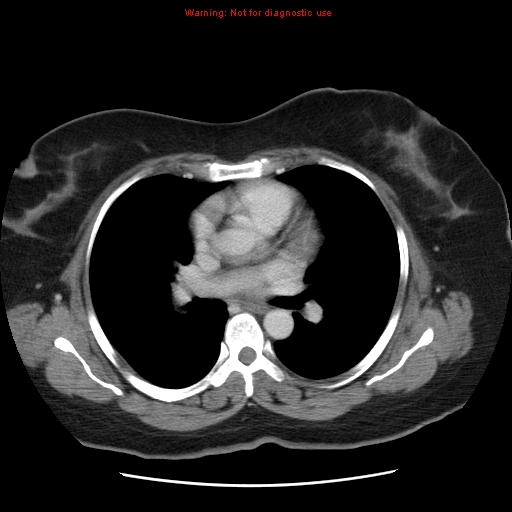Acute appendicitis complicated by ovarian vein thrombophlebitis (Radiopaedia 16172-15851 Axial C+ portal venous phase 1).jpg