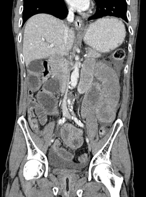 Acute bowel ischemia (Radiopaedia 87695-104114 Coronal C+ portal venous phase 207).jpg