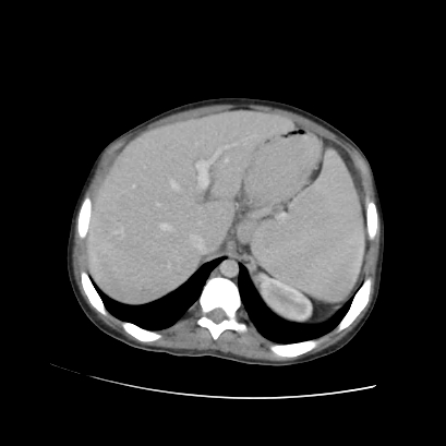 File:Acute calculous cholecystitis in patient with osteopetrosis (Radiopaedia 77871-90159 Axial C+ portal venous phase 24).jpg