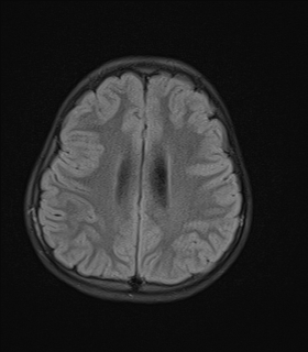 File:Acute cerebellar ataxia (Radiopaedia 61487-69446 Axial FLAIR 15).jpg
