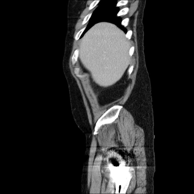 Acute cholecystitis and incidental left sided IVC (Radiopaedia 49352-54459 Sagittal C+ portal venous phase 78).jpg