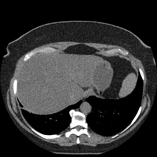 File:Acute cholecystitis and ureteric colic (Radiopaedia 42330-45444 Axial prone 1).jpg