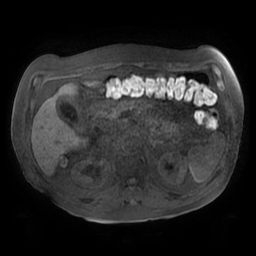 File:Acute cholecystitis complicated by pylephlebitis (Radiopaedia 65782-74915 Axial T1 fat sat 59).jpg