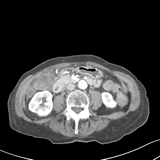 Acute cholecystitis with contained perforation (Radiopaedia 47328-51907 Axial C+ portal venous phase 37).png