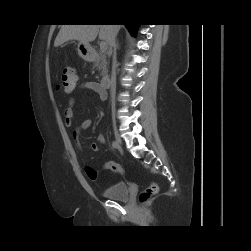 Acute cholecystitis with tensile fundus sign (Radiopaedia 71394-81723 Sagittal non-contrast 82).jpg