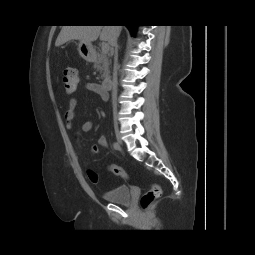 File:Acute cholecystitis with tensile fundus sign (Radiopaedia 71394-81723 Sagittal non-contrast 83).jpg