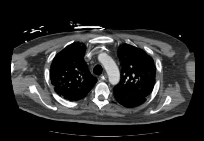 File:Acute cor pulmonale (ultrasound) (Radiopaedia 83508-98818 Axial 142).jpg