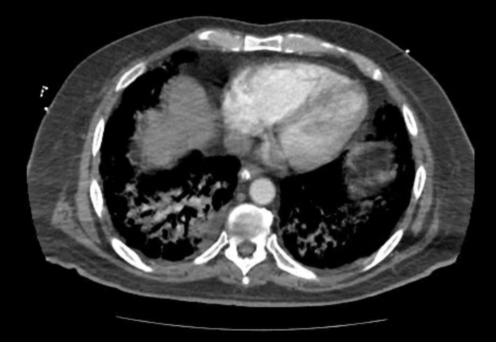 File:Acute cor pulmonale (ultrasound) (Radiopaedia 83508-98818 Axial C+ CTPA 57).jpg