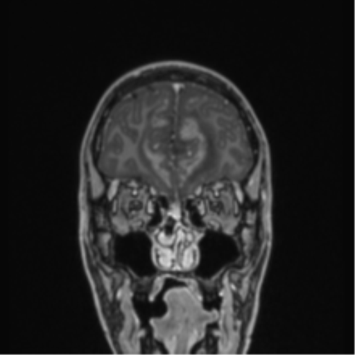Acute disseminated encephalomyelitis (ADEM) (Radiopaedia 65319-74349 Coronal T1 C+ 54).png