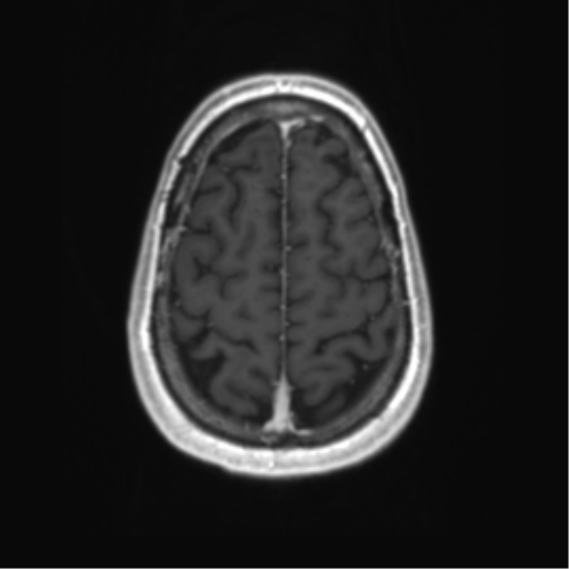 Acute disseminated encephalomyelitis (ADEM) (Radiopaedia 65319-74350 Axial T1 C+ 55).png