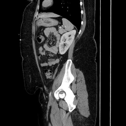 Acute diverticulitis - transverse colon (Radiopaedia 87063-103327 Sagittal C+ portal venous phase 159).jpg