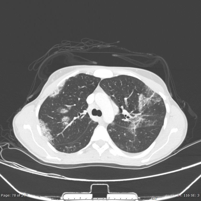 Acute eosinophilic pneumonia (Radiopaedia 48211-53073 Axial lung window 28).jpg