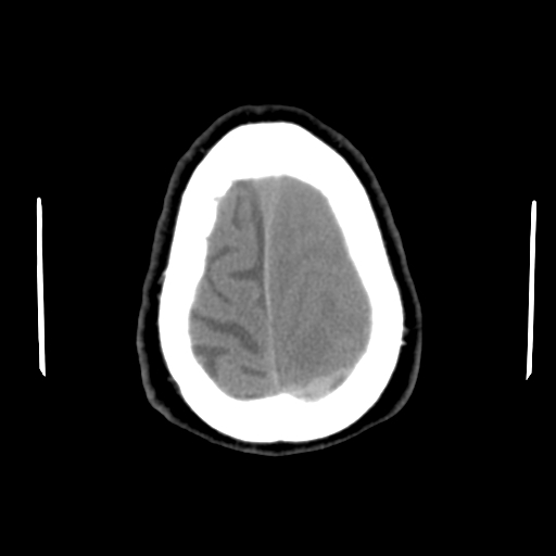 Acute hemorrhagic stroke (Radiopaedia 17507-17223 Axial non-contrast 46).jpg