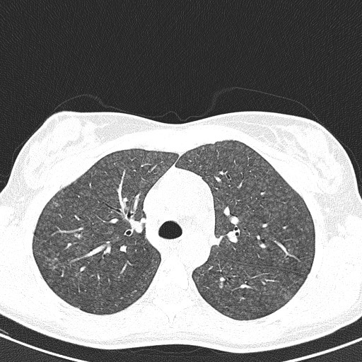 File:Acute hypersensitivity pneumonitis (Radiopaedia 85293-100870 Axial lung window 37).jpg
