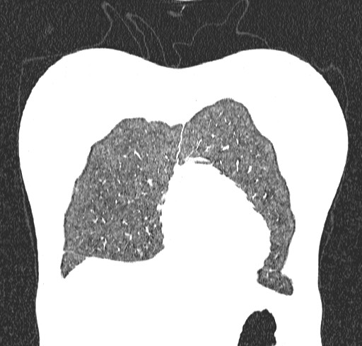 Acute hypersensitivity pneumonitis (Radiopaedia 85293-100870 Coronal lung window 12).jpg